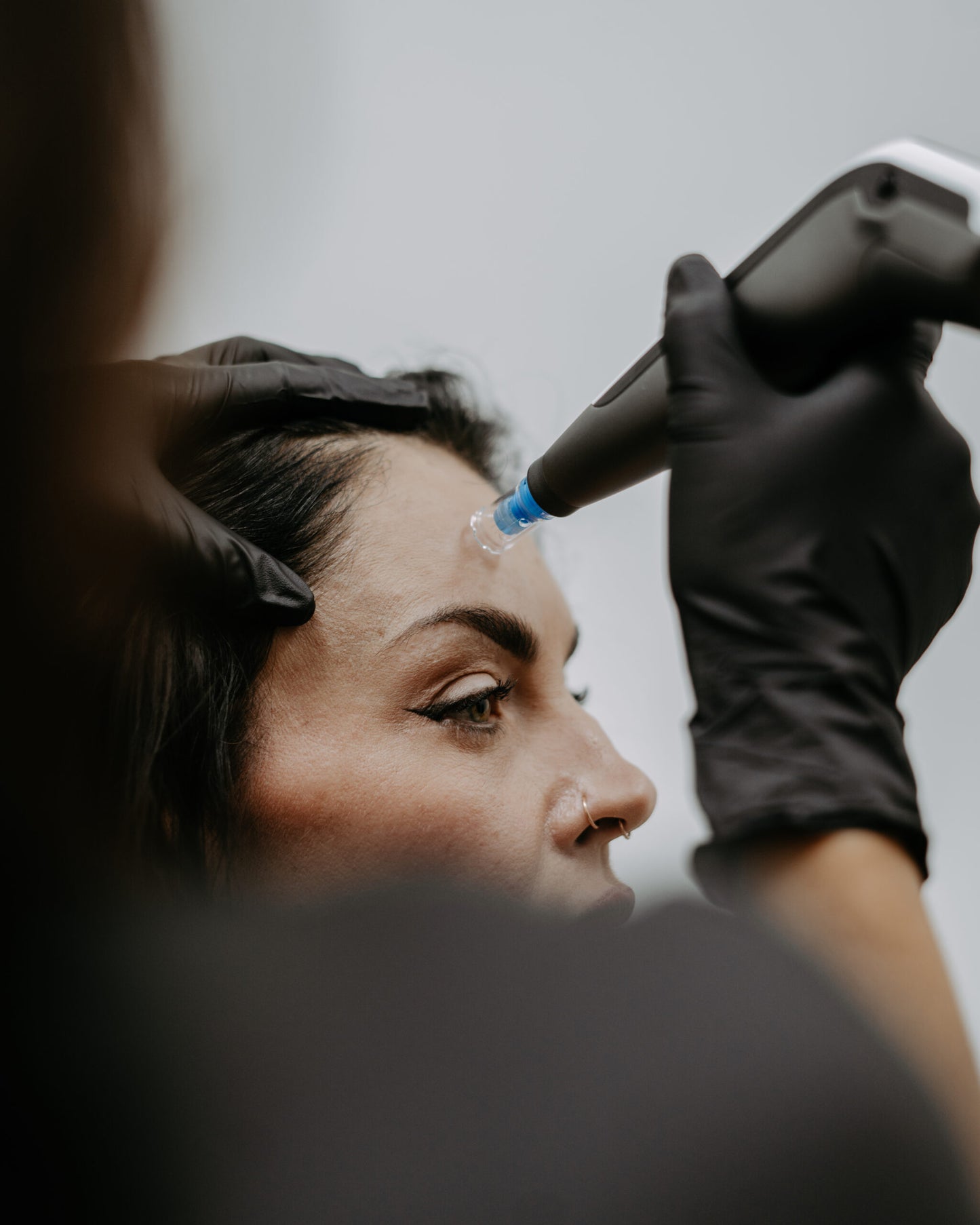 Microneedling image 0