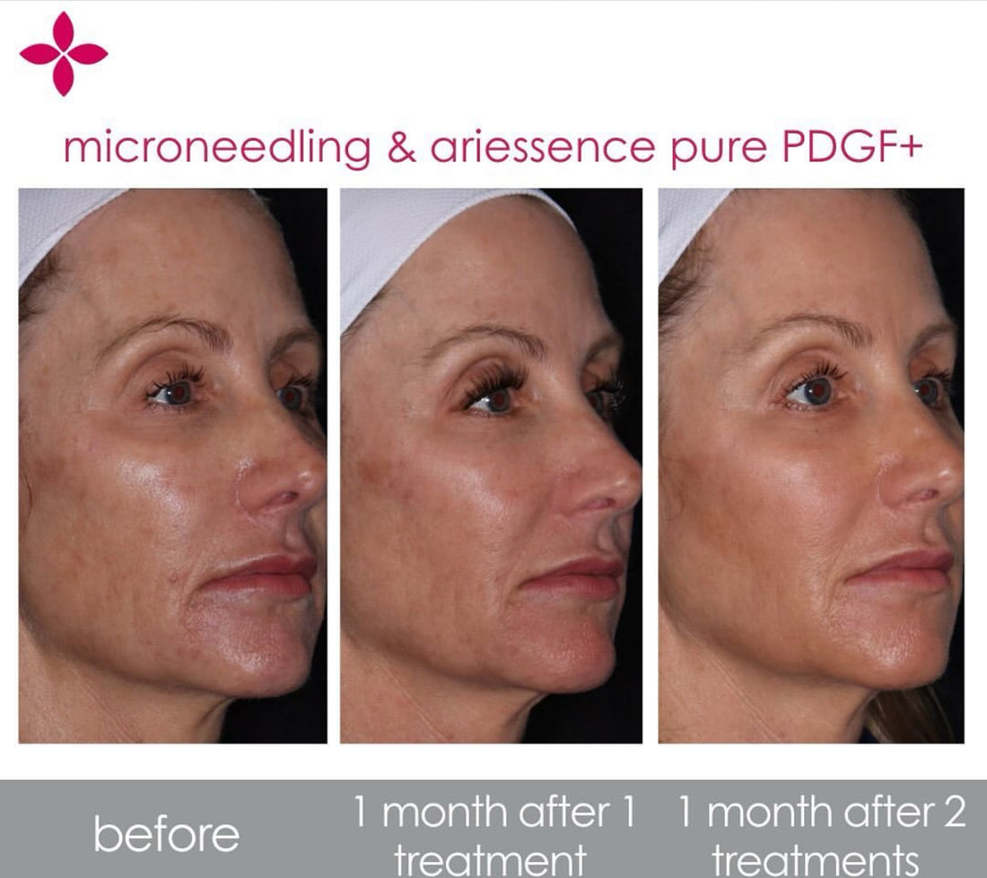 Ariessence Injections: How Long They Last, Downtime, and Treatment Plan