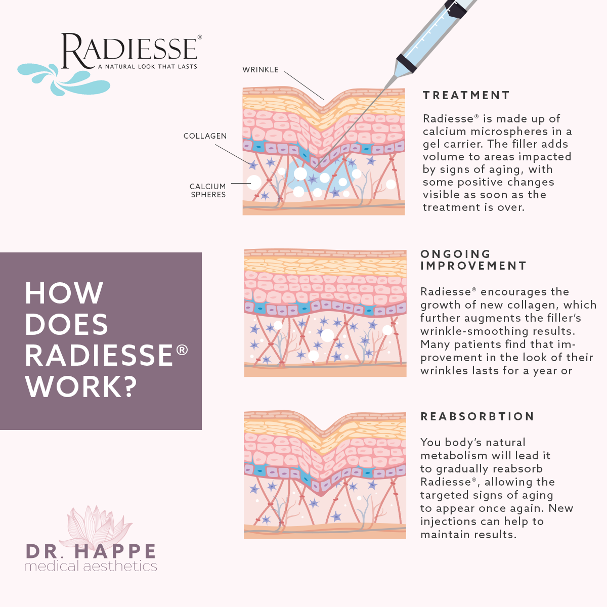 Radiesse Filler image 2