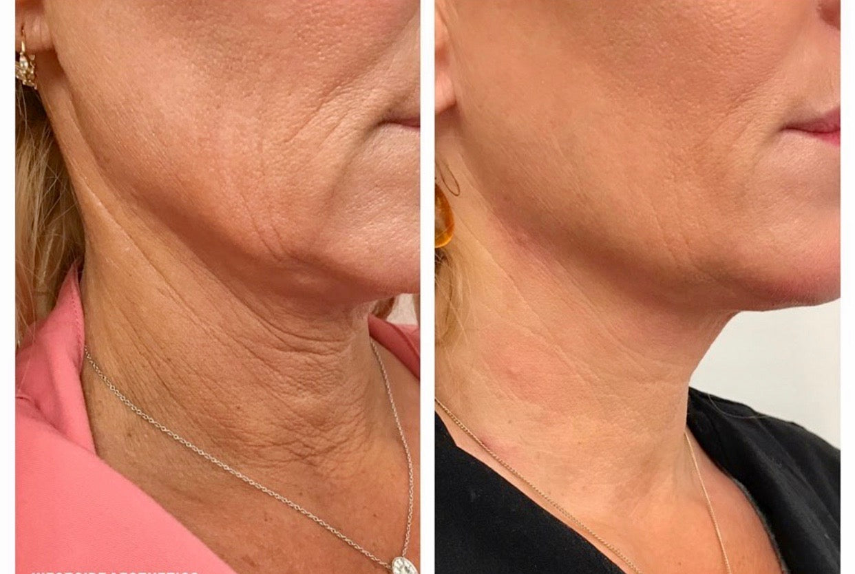 Radiesse Filler image 1