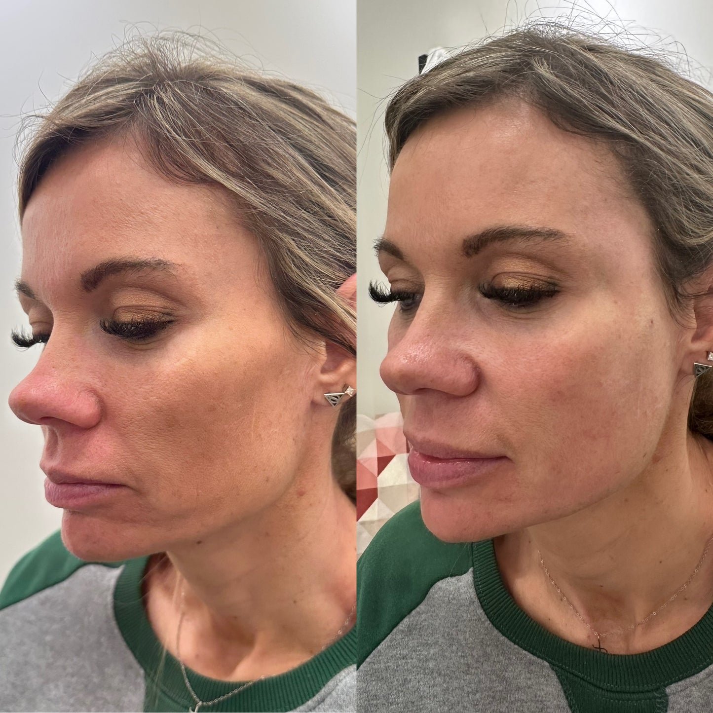 Radiesse Filler image 5