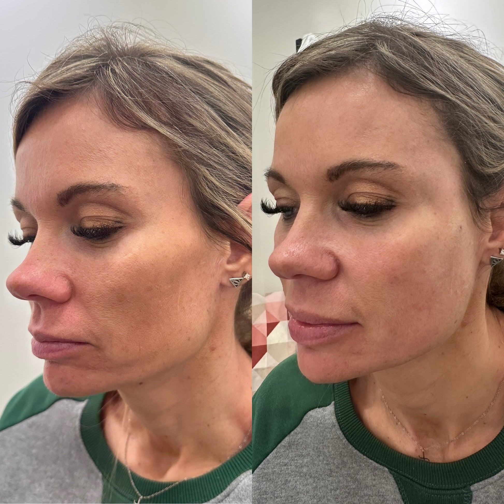 Radiesse Filler image 5