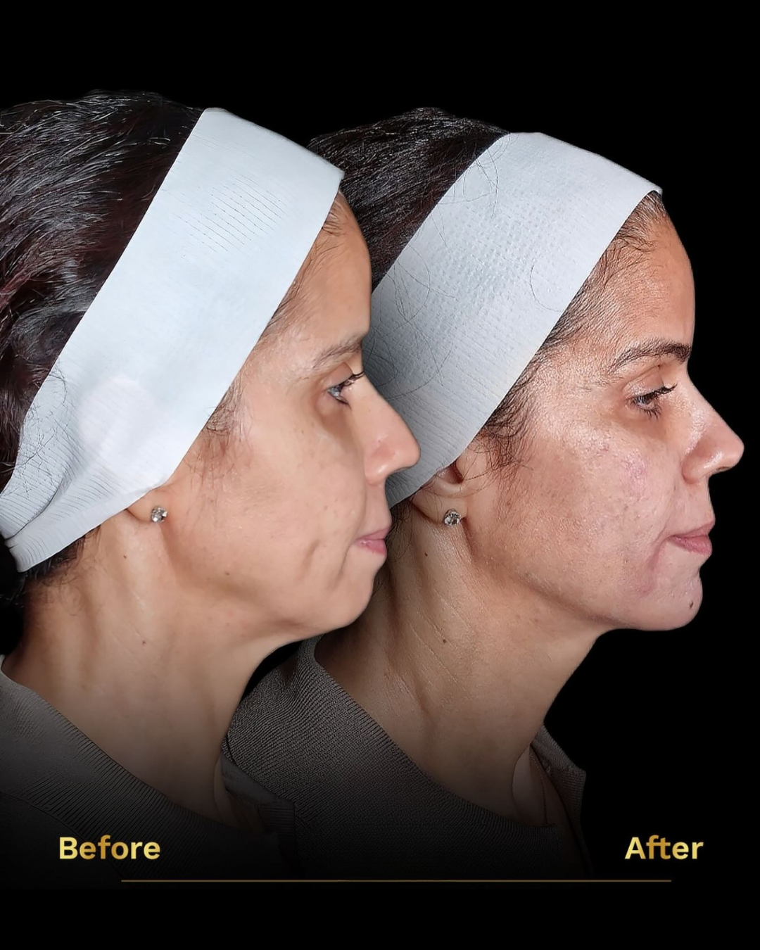 Full Face Rejuvenation image 0